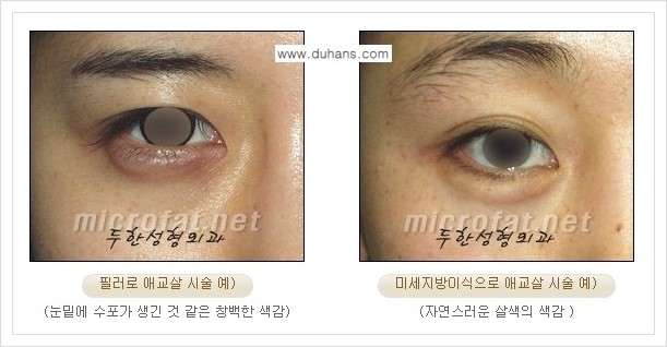 [두한성형외과 경쟁력 눈밑성형] - [눈밑 애교살 시술을 위한 미세지방이식] 관련 이미지 14