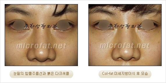 [두한성형외과 경쟁력 눈밑성형] - [Dr. 컬럼 - 눈밑 다크써클의 치료 방법과 치료 효과] 관련 이미지 11