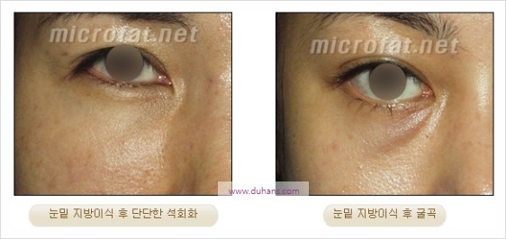 [두한성형외과 경쟁력 지방이식] - [두한 자가지방이식 클리닉 안내]​ 관련 이미지 59