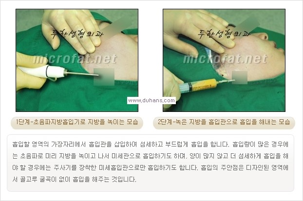 ​​[두한성형외과 경쟁력 지방흡입] - [아름다운 얼굴 윤곽선을 위한  볼살지방흡입, 턱선지방흡입 안내] 관련 이미지 6