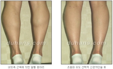 [두한성형외과 종아리 퇴축] - [종아리 퇴축술 재발 재수술] 관련 이미지 21