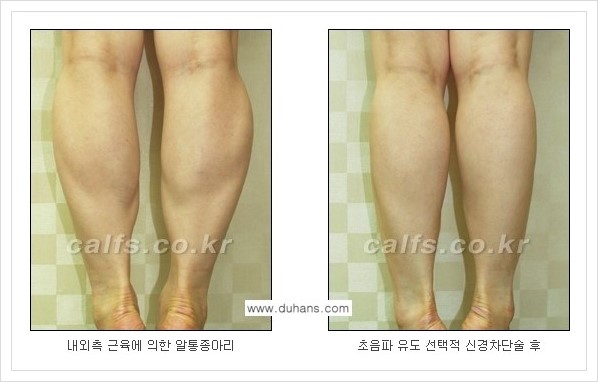 [두한성형외과의 경쟁력 멀티 종아리성형] - [근육퇴축을 위한 초음파 유도 선택적 신경차단술 안내] 관련 이미지 10