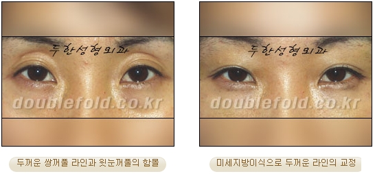 [두한성형외과 쌍커풀수술] - [눈성형 방법에 대한 자주하는 질문과 답변] 관련 이미지 89
