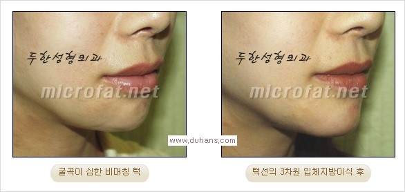 ⁠⁠[두한성형외과 경쟁력 미세지방이식] - [턱 미세지방이식 - 안면윤곽 교정 안내] 관련 이미지 22