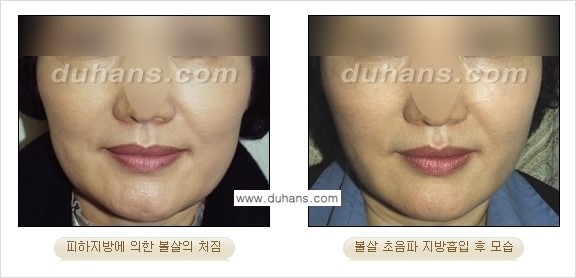 ​​​﻿[두한성형외과 경쟁력 간편지방흡입] - [볼살지방흡입, 턱선지방흡입 안내] 관련 이미지 2