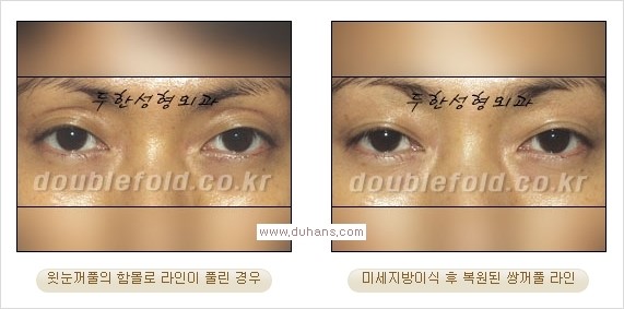 ​⁠⁠[두한성형외과 경쟁력 쌍꺼풀 재수술, 극한 눈재수술] - [지방이식으로 눈매와 쌍꺼풀 라인을 교정] 관련 이미지 16