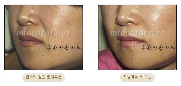 [두한성형외과 경쟁력 안티에이징 동안성형] - [주름이 깊은 푹~ 꺼진 입가 팔자주름 안녕!] 관련 이미지 17