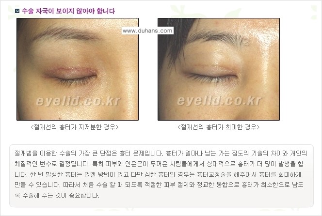 [두한성형외과 경쟁력 눈성형] - [퀵쌍꺼풀(부분절개법) 수술 안내] 관련 이미지 3