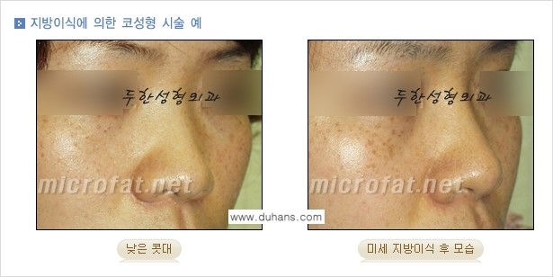 ​[두한성형외과의 No.1 경쟁력 미세(자가)지방이식] - [코높힘 미세(자가)지방이식 ②] 관련 이미지 2