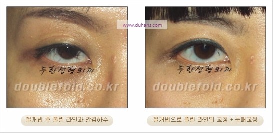 [두한성형외과 경쟁력 쌍꺼풀 재수술] - [풀린 라인 교정(Correction released fold line) 방법] 관련 이미지 5