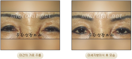 [두한성형외과 자가지방이식] - [미간주름] 관련 이미지 15