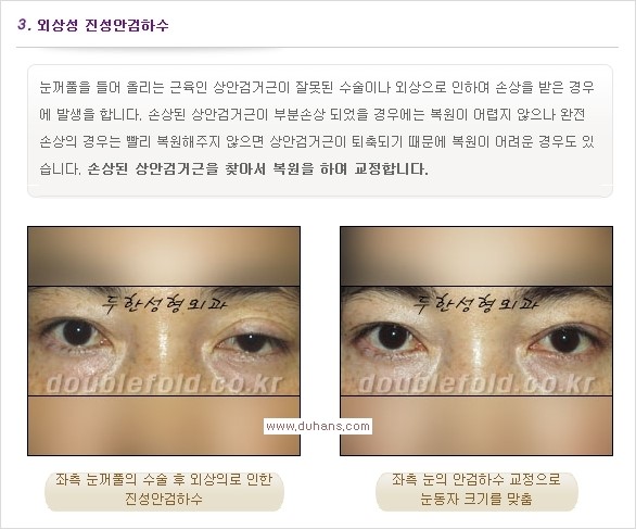 [두한성형외과 경쟁력 쌍꺼풀 재수술, 극한 눈재수술] - [안검하수 종류 안내] 관련 이미지 6