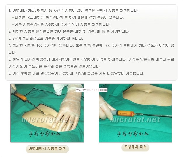 [두한성형외과 경쟁력 눈밑성형] - [눈밑 미세지방이식으로 다크써클 치료] 관련 이미지 7