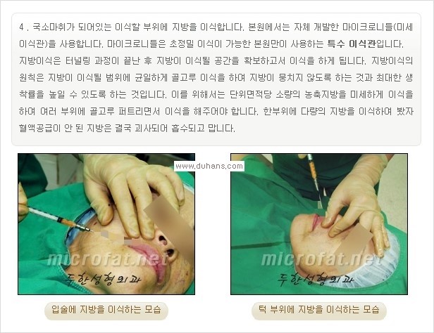 [두한성형외과 경쟁력 미세지방이식] - [입체 미세지방이식으로 주름을 펴면서 볼륨감 있는 입술 만들기] 관련 이미지 5