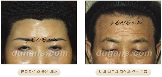 [Duhan Plastic Surgery Wrinkle Removal] - [Wrinkle Removal Treatment Methods] image 3