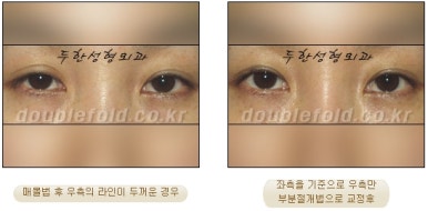 Best Place for Double Eyelid Revision Surgery, Duhan Plastic Surgery - Partial Incision Eye Revision Surgery image 33