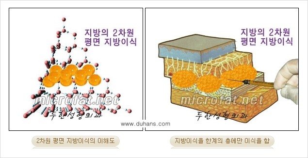 [두한성형외과 경쟁력 미세지방이식] - [3차원 입체지방이식과 2차원 평면지방이식의 차이점] 관련 이미지 2