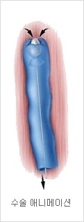 [두한성형외과 경쟁력 정맥류 치료] - [정맥류와 정맥확장증 치료] 관련 이미지 3