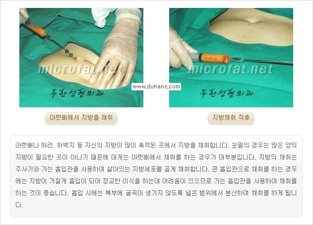 [두한성형외과 경쟁력 눈밑성형] - [눈밑 애교살 - 이상적인 눈밑 미세지방이식 방법] 관련 이미지 4