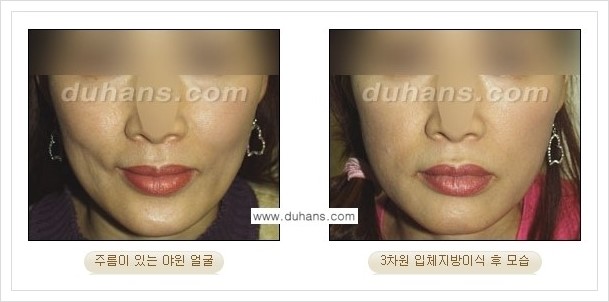 [두한성형외과 경쟁력 얼굴미세지방이식] - [볼살지방이식, 이마지방이식, 측두부지방이식 안내] 관련 이미지 6