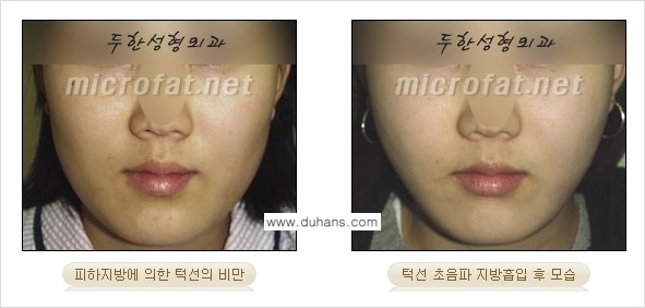 [두한성형외과 경쟁력 지방흡입] - [얼굴, 볼살, 턱살, 턱선의 초음파 지방흡입] 관련 이미지 11