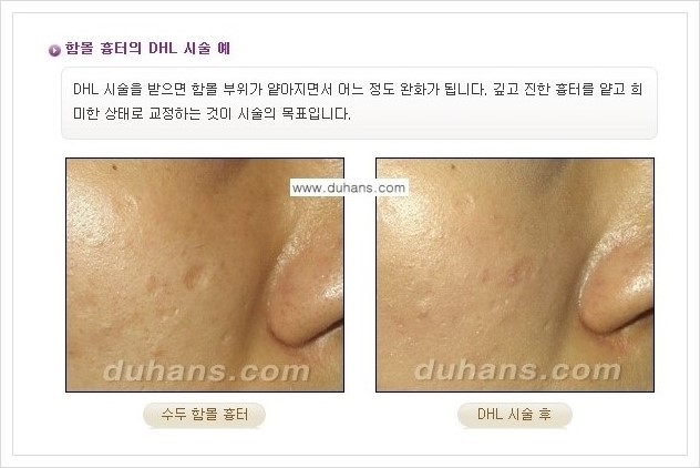 [두한성형외과 경쟁력 함몰흉터교정] - [함몰흉터의 DHC 시술 안내] 관련 이미지 9