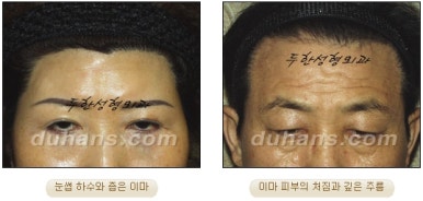 [두한성형외과 주름개선] - [주름교정 방법] 관련 이미지 3