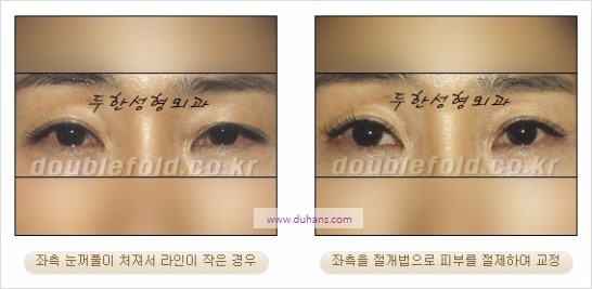 [두한성형외과 경쟁력 눈성형] - [비대칭 쌍꺼풀 라인의 여러 가지 교정 방법] 관련 이미지 10