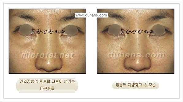 [두한성형외과 경쟁력 안검성형] - [눈밑 지방제거 안내] 관련 이미지 6