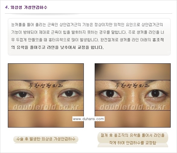 [두한성형외과 NO.1 "극한 눈(쌍꺼풀 재수술)"] - [안검하수(졸린눈매) 재수술 안내 1.] 관련 이미지 7