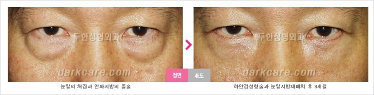 ​[두한성형외과 경쟁력 눈밑성형 리더] - [눈밑 다크써클의 증상, 원인, 종류, 치료방법 안내] 관련 이미지 68