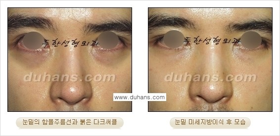 [두한성형외과 상큼하고 환한 눈매완성] - [눈밑 미세지방이식 ①] 관련 이미지 16