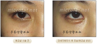 두한성형외과 눈밑성형 - 애교필러 후 눈밑재수술 관련 이미지 47