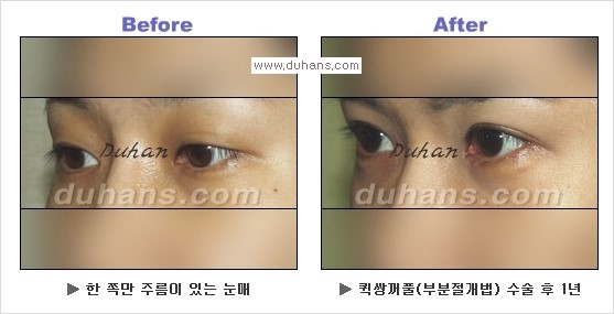[두한성형외과 경쟁력 눈성형] - [Dr. 컬럼  "어떤 쌍꺼풀이 아름다운 쌍꺼풀인가?!] 관련 이미지 14