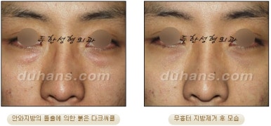 [두한성형외과 지방제거] - [눈두덩이지방제거, 눈밑지방제거] 관련 이미지 49