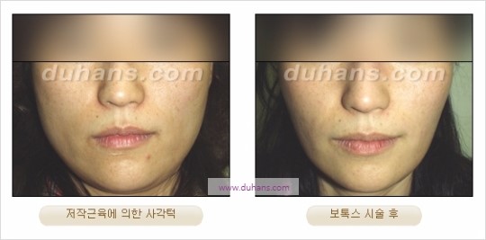 [두한성형외과 경쟁력 안면윤곽성형] - [보톡스(보툴리눔톡신)에 의한 사각턱 교정] 관련 이미지 6