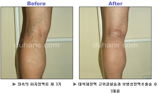 [두한성형외과 정맥류] - [하지정맥류, 정맥확장증, 혈관확장증] 관련 이미지 27