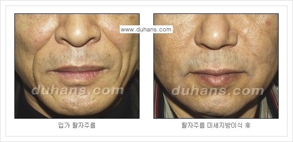 ​[두한성형외과 경쟁력 주름성형] - [주름교정을 위한 미세지방이식 안내 2.] 관련 이미지 4