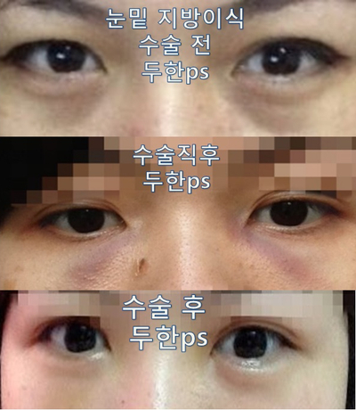 [두한성형외과 다크서클] - [다크서클 전후사진 검증] 관련 이미지 203