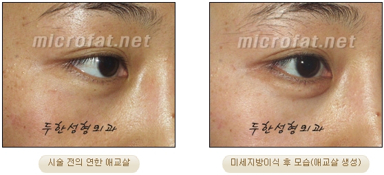Duhan Plastic Surgery Under-Eye Surgery - Correction with Fat Grafting After Aegyo-Sal Filler image 23