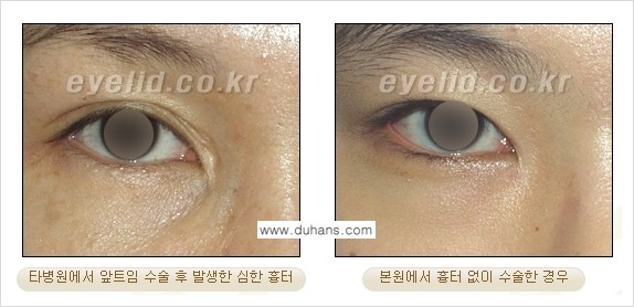 [두한성형외과 눈성형 FOCUS] - [몽고주름 제거(앞트임 제거) 수술 ③] 관련 이미지 7