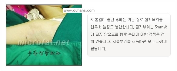[두한성형외과 경쟁력 액취증, 다한증 치료] - [겨드랑이의 참기 힘든 냄새와 땀 치료 - 초음파 컷터지방흡입 + 리포셋 소파흡입술] 관련 이미지 18