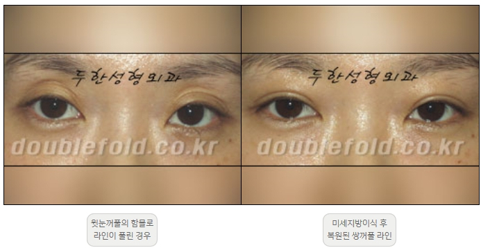 [두한성형외과 쌍커풀재수술] - [풀린 쌍커풀라인 교정] 관련 이미지 13