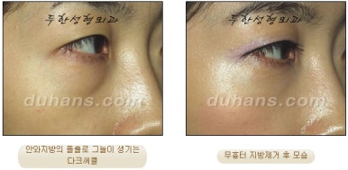 [두한성형외과 지방제거] - [눈두덩이지방제거, 눈밑지방제거] 관련 이미지 30