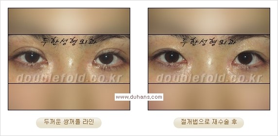 [두한성형외과 경쟁력 쌍꺼풀 재수술] - [쌍꺼풀 재수술 과정] 관련 이미지 68
