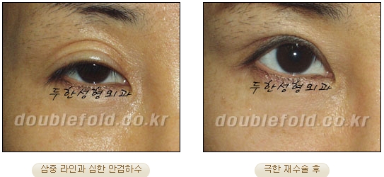 [DoubleFold Plastic Surgery Eye Surgery] - [Revision Surgery for Thick Double Eyelids] image 50