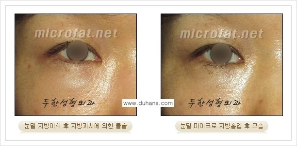 [두한성형외과 겨울엔 지방흡입을] - [볼살, 눈밑, 턱선의 초음파 미세지방흡입 2.] 관련 이미지 9