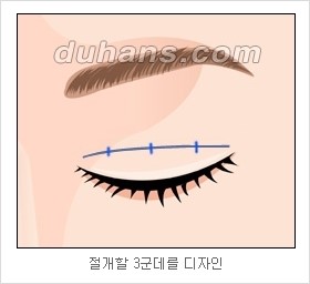 [두한성형외과 경쟁력 눈성형 리더] - [아름다운 눈매를 위한 쌍꺼풀 수술 안내] 관련 이미지 3