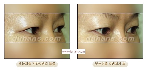 ⁠⁠[두한성형외과 경쟁력 안검성형] - [젊은 눈매를 위한 윗눈꺼풀 지방제거, 눈밑 지방제거] 관련 이미지 11