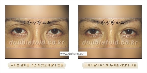 [두한성형외과 NO.1 눈성형] - [함몰된(꺼진) 눈꺼풀에서 쌍꺼풀 라인 교정 2.] 관련 이미지 7